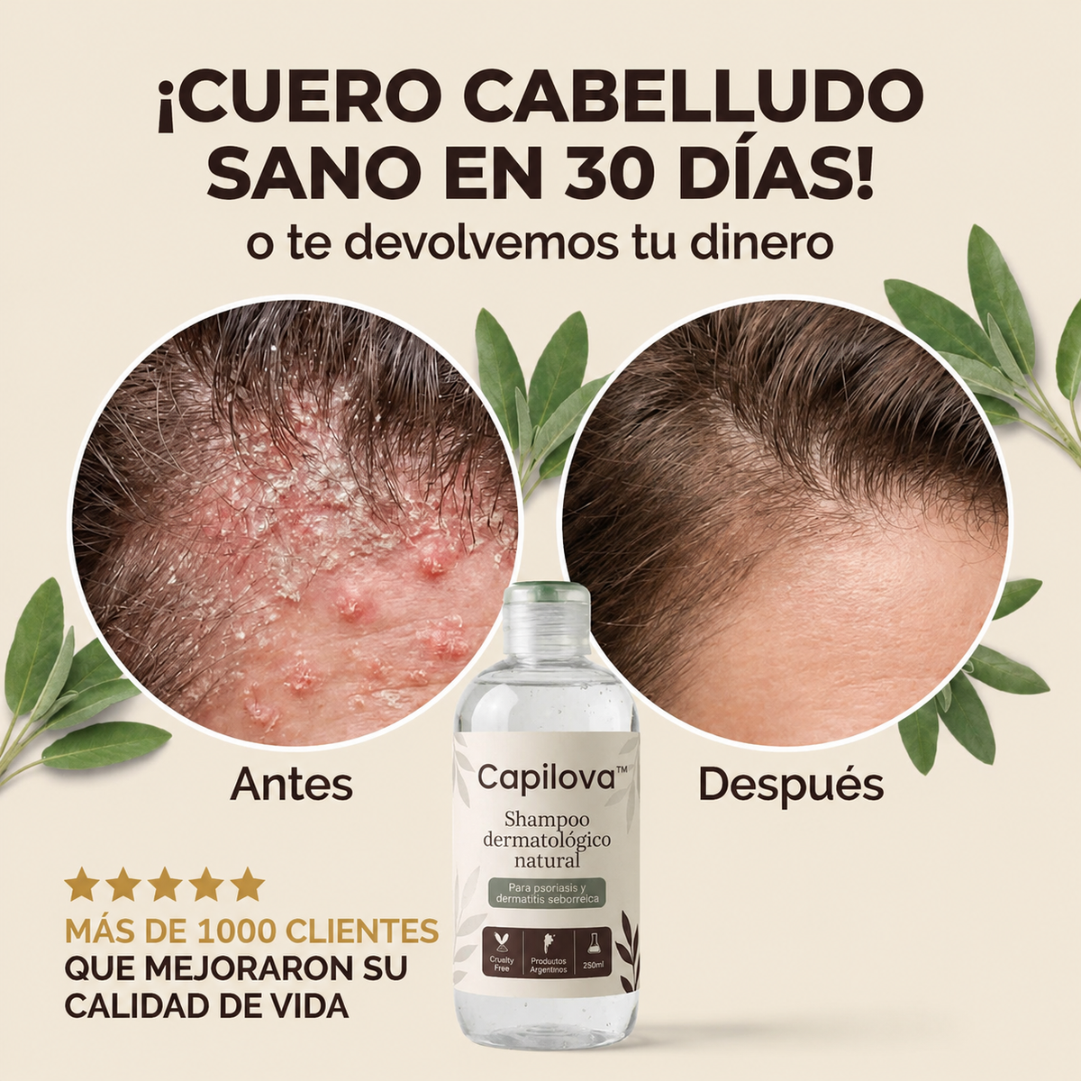 Capilova™ | Champú para la Caspa, Psoriasis Capilar y Dermatitis Seborreica