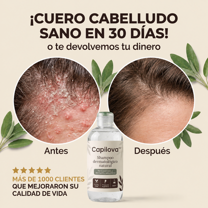 Capilova™ | Champú para la Caspa, Psoriasis Capilar y Dermatitis Seborreica