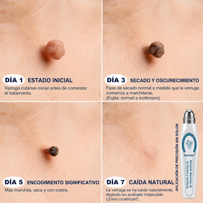 Dermo™Elimina Verrugas y Manchas en 7 Días