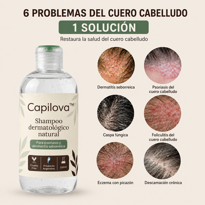 Capilova™ | Champú para la Caspa, Psoriasis Capilar y Dermatitis Seborreica