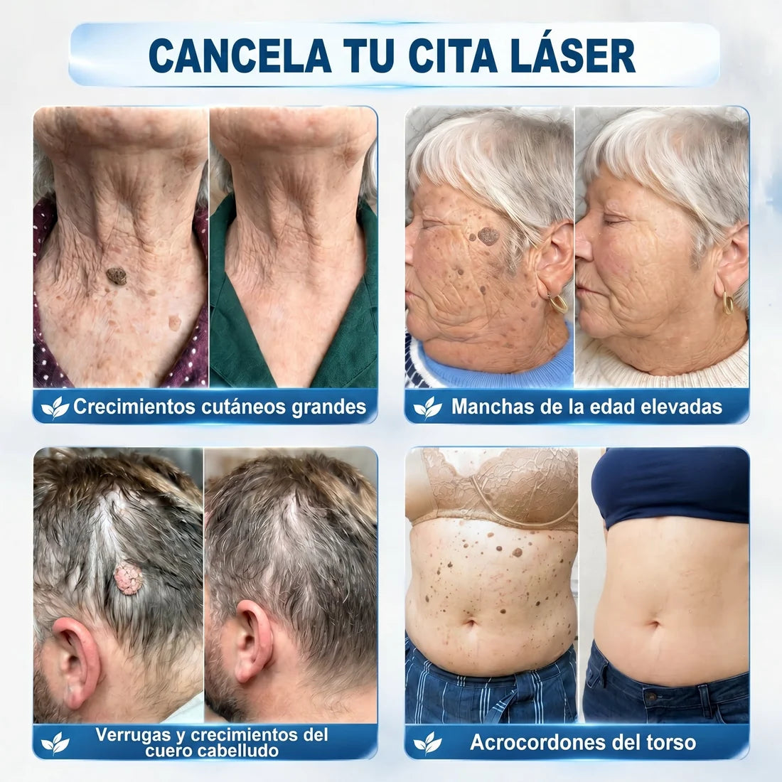 Dermo™Elimina Verrugas y Manchas en 7 Días