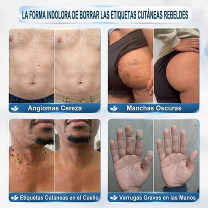 Dermo™Elimina Verrugas y Manchas en 7 Días
