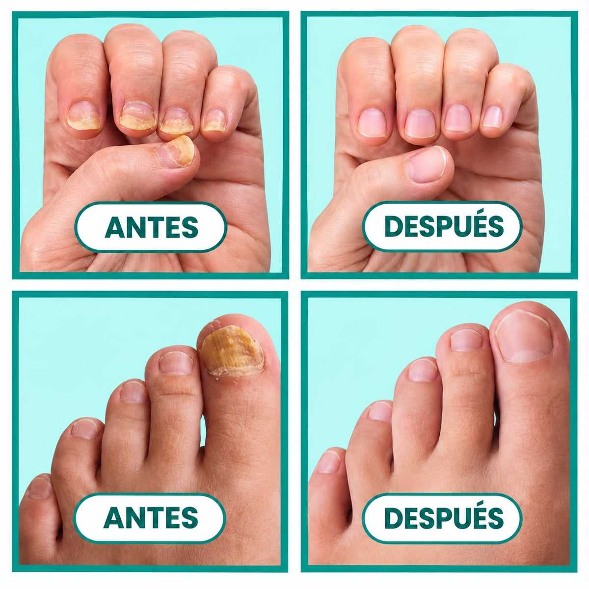 Adiós a los hongos en las uñas con Onyvia V3