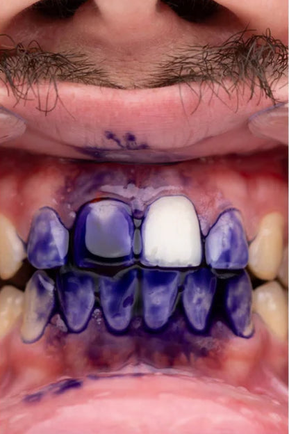 Dentéa™ V34 — Blanqueamiento Dental en Casa