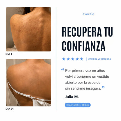 Bacnova™ Barra Antiacné