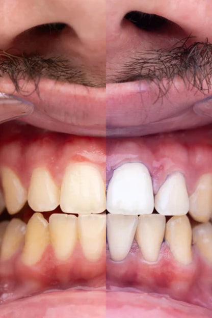 Dentéa™ V34 — Blanqueamiento Dental en Casa