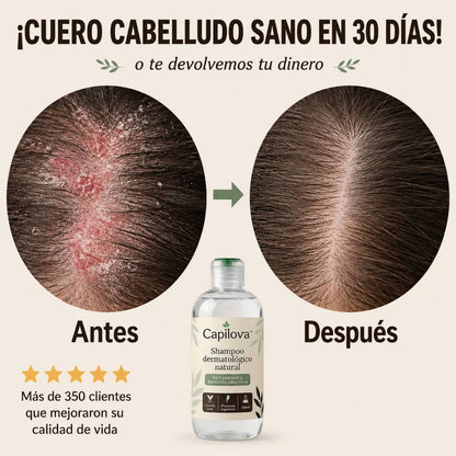 Capilova™ | Champú para la Caspa, Psoriasis Capilar y Dermatitis Seborreica