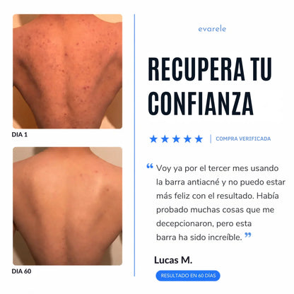 Bacnova™ Barra Antiacné