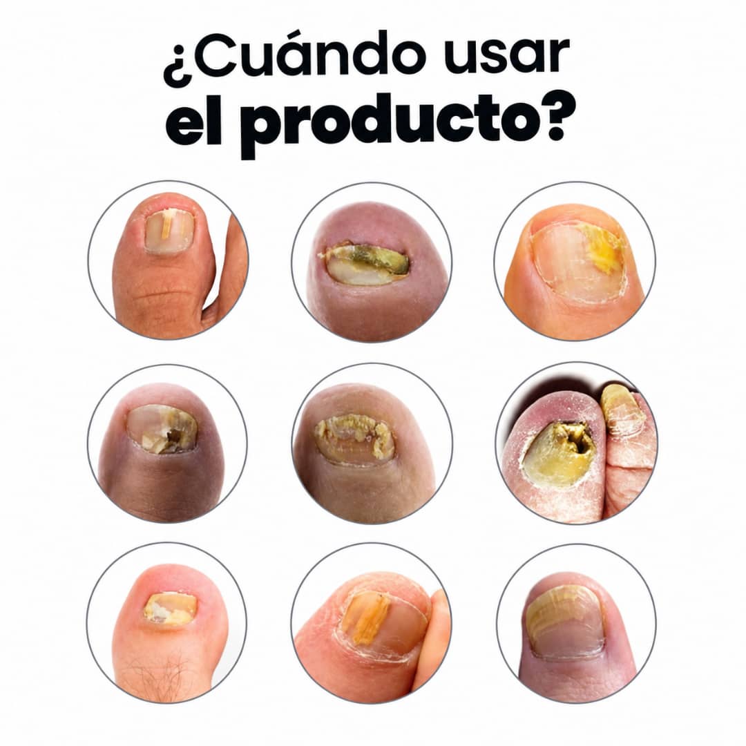 Adiós a los hongos en las uñas con Onyvia V3