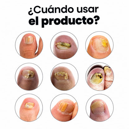 Adiós a los hongos en las uñas con Onyvia V3